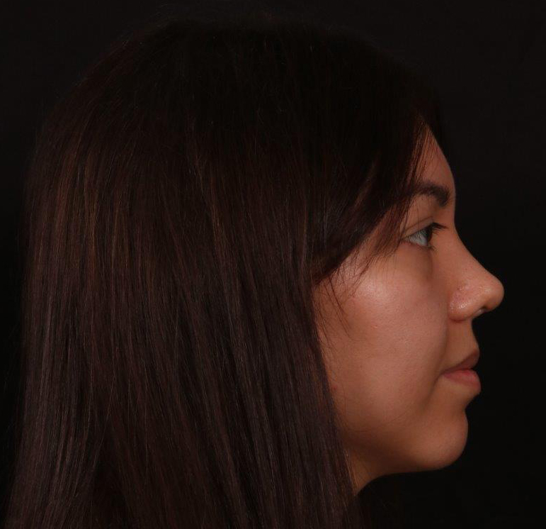 After Image: Revision Rhinoplasty - right-side