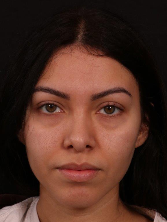 Before Image: Revision Rhinoplasty - front