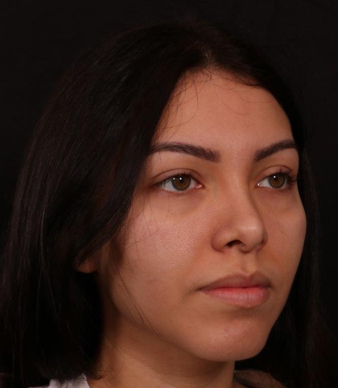 Before Image: Revision Rhinoplasty - right-front-oblique