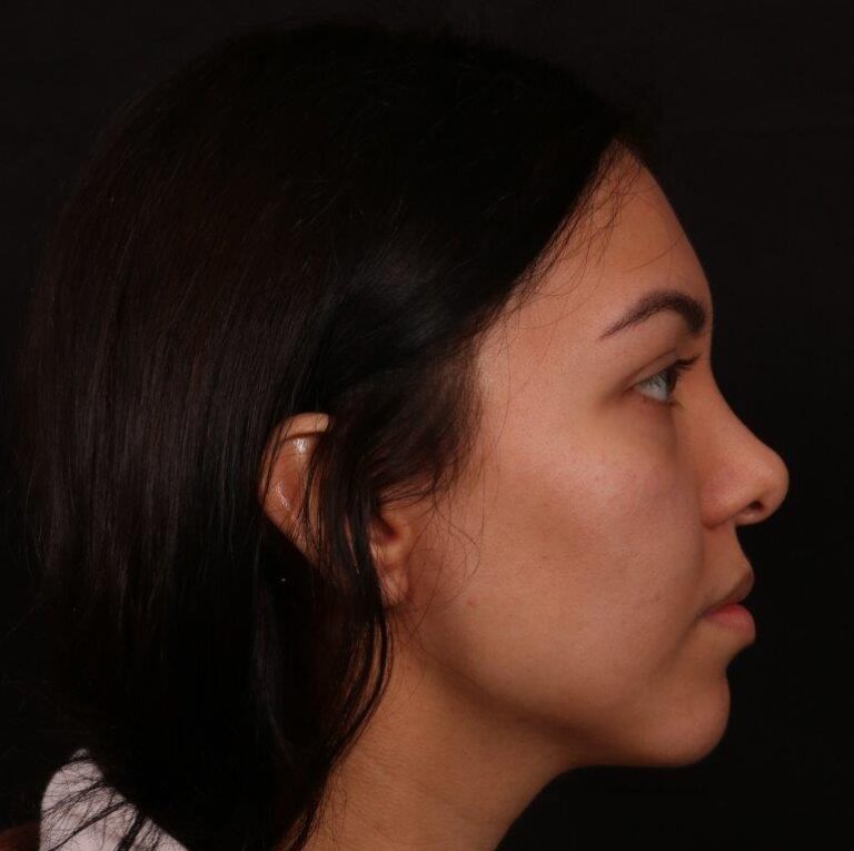 Before Image: Revision Rhinoplasty - right-side