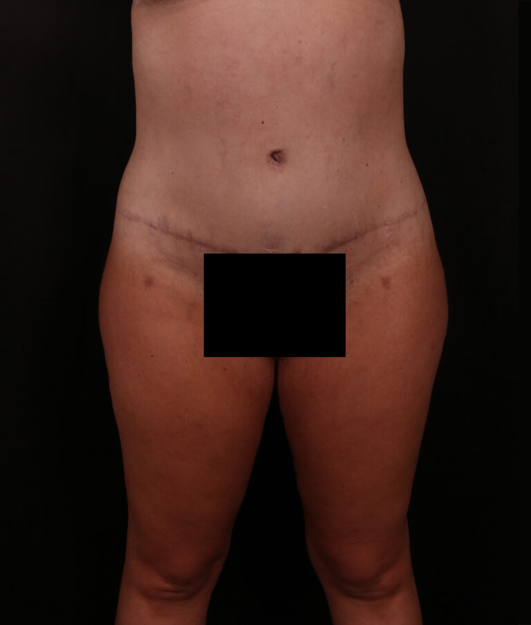 After Image: Tummy Tuck - front