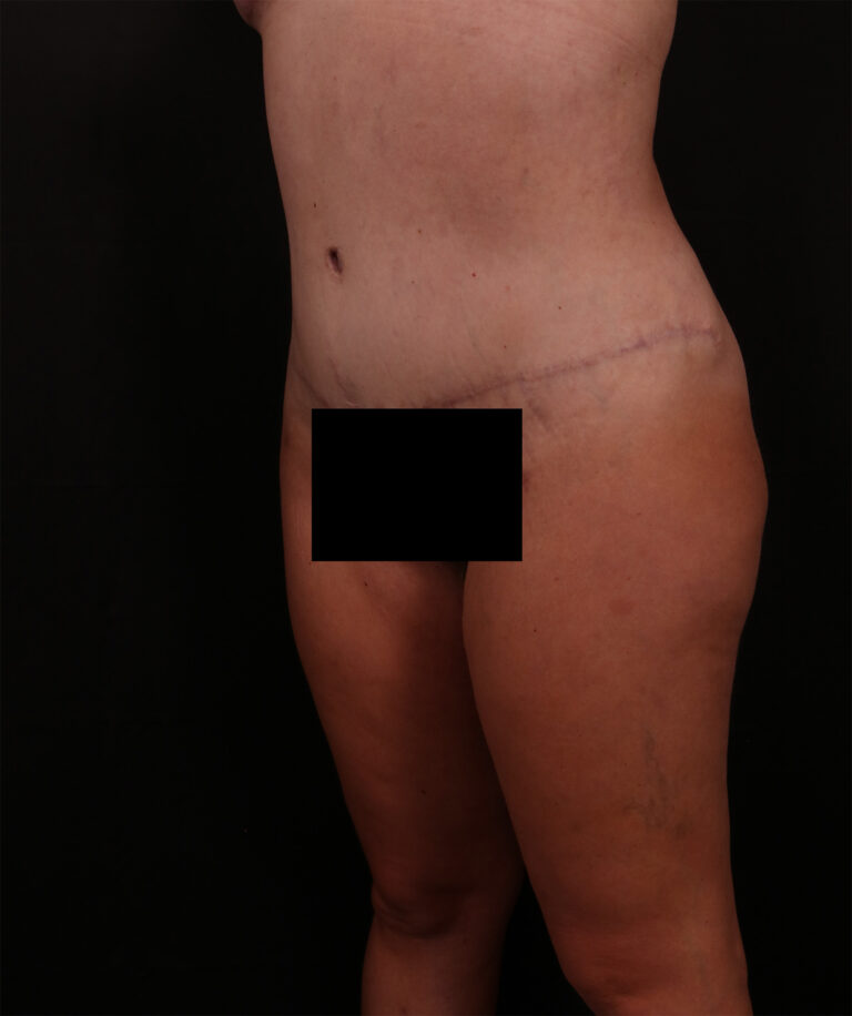 After Image: Tummy Tuck - left-front-oblique