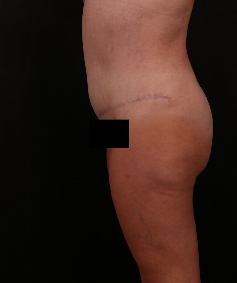 After Image: Tummy Tuck - left-side