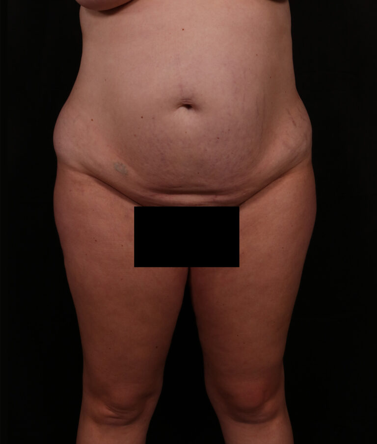 Before Image: Tummy Tuck - front