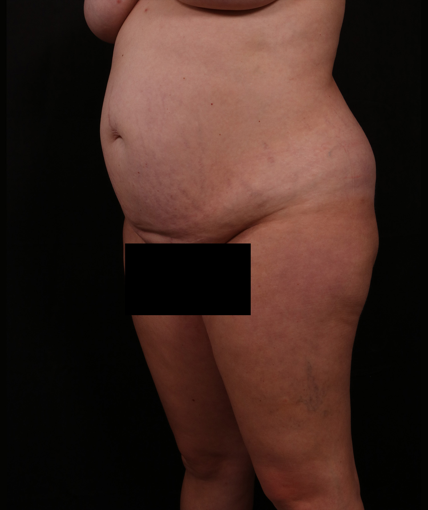 Before Image: Tummy Tuck - left-front-oblique