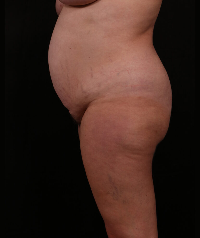 Before Image: Tummy Tuck - left-side