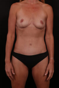 After Image: Mommy Makeover