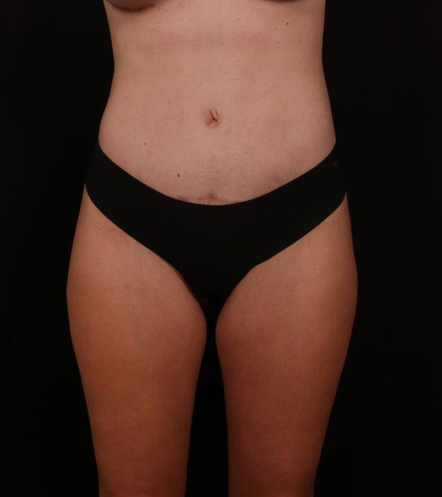 After Image: Tummy Tuck - front