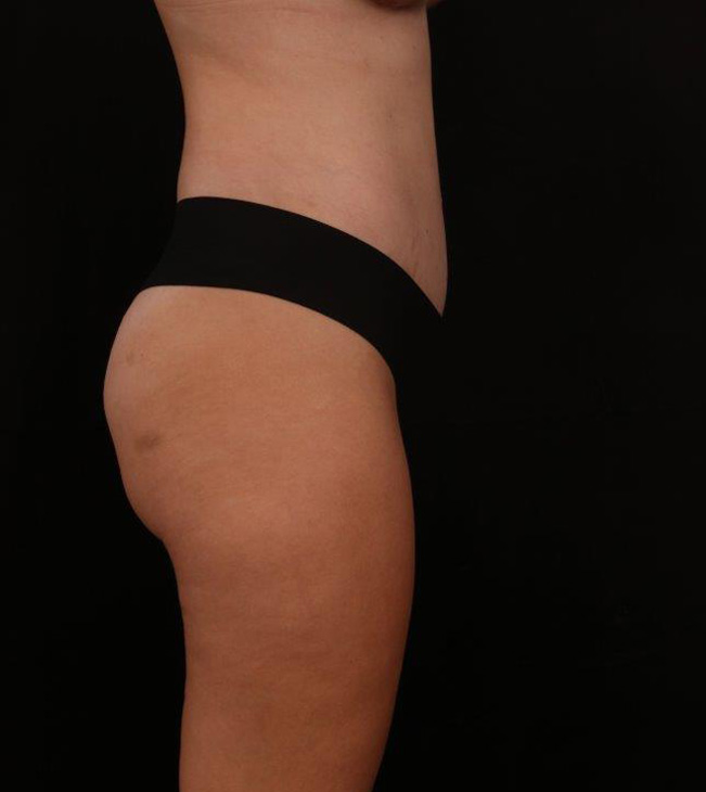 After Image: Tummy Tuck - right-side