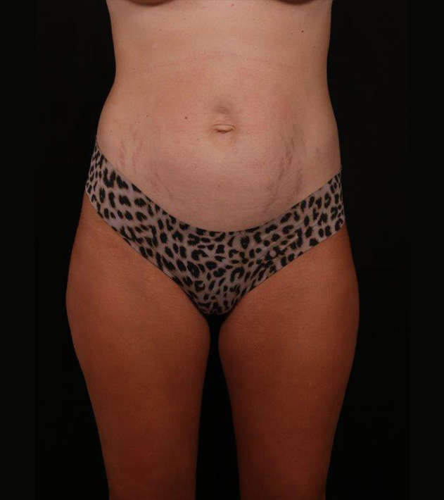 Before Image: Tummy Tuck - front