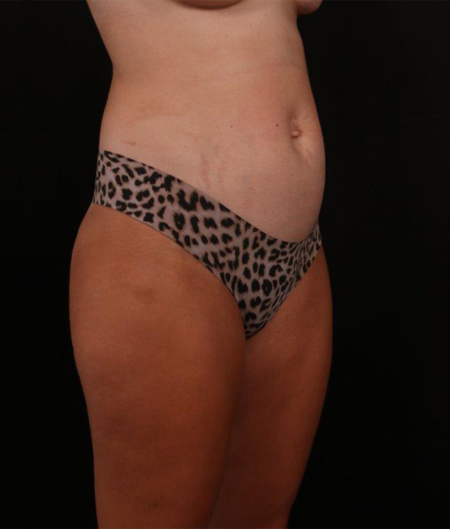 Before Image: Tummy Tuck - right-front-oblique