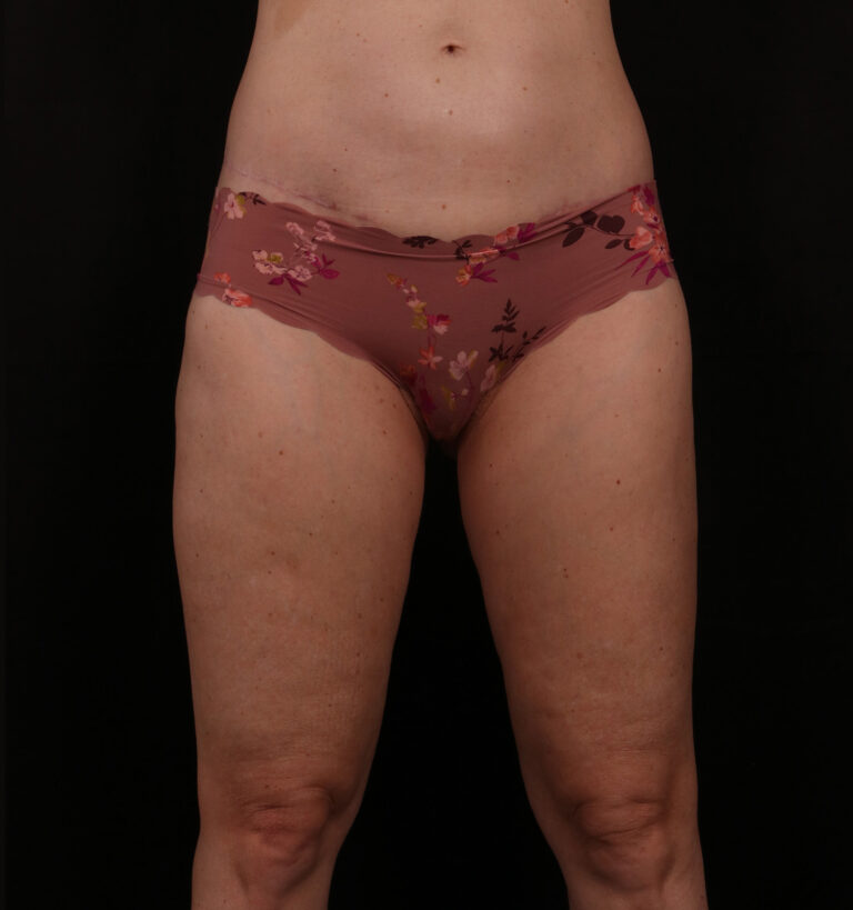 After Image: Outer Thigh Lift - front