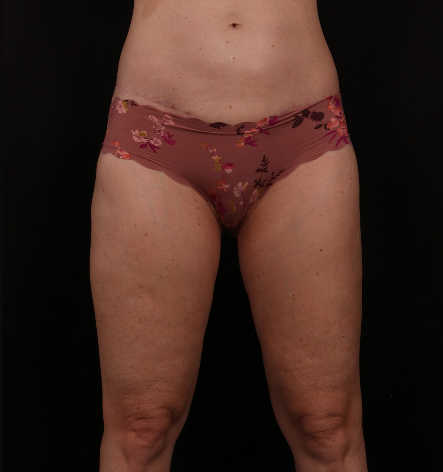 After Image: Outer Thigh Lift - front