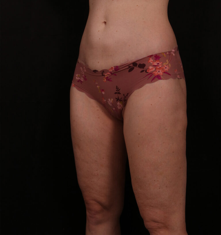 After Image: Outer Thigh Lift - left-front-oblique