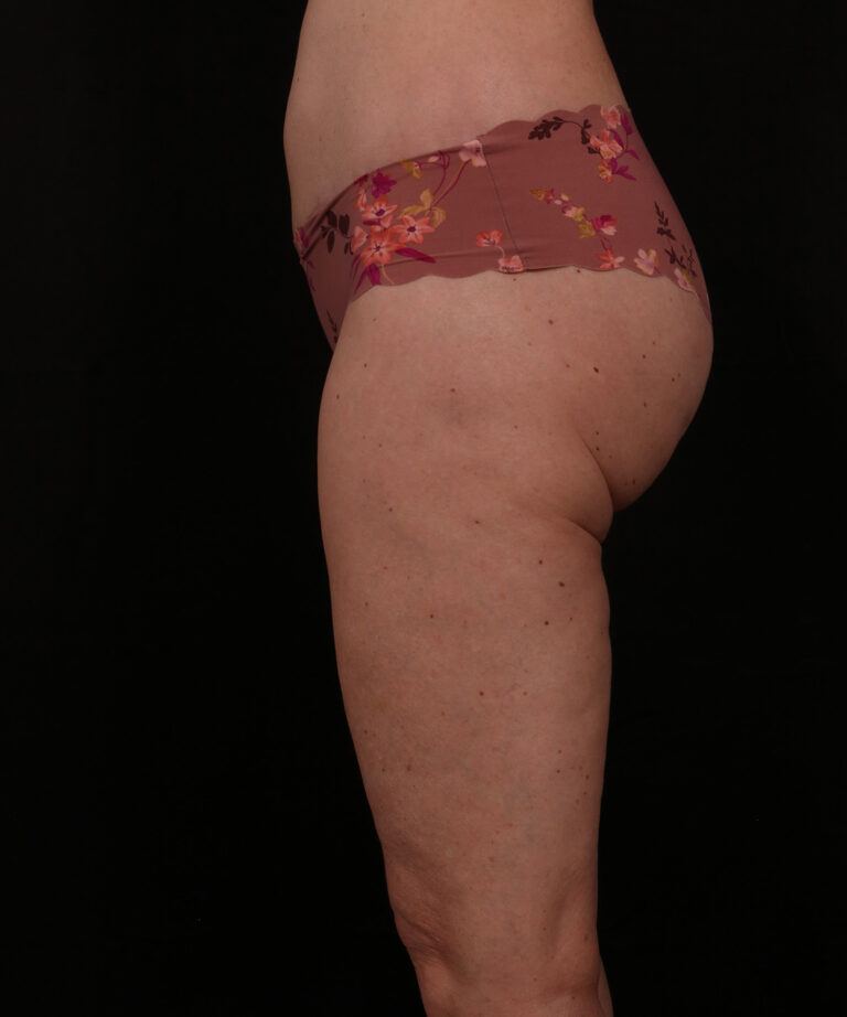 After Image: Outer Thigh Lift - left-side