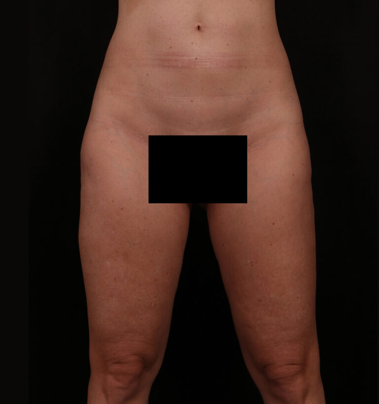 Before Image: Outer Thigh Lift - front
