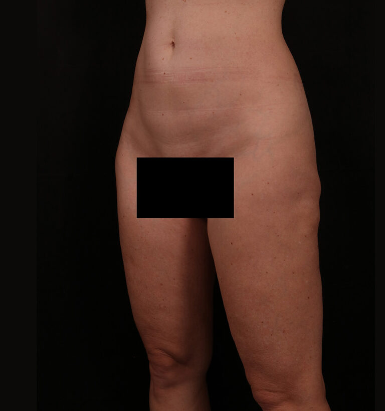 Before Image: Outer Thigh Lift - left-front-oblique