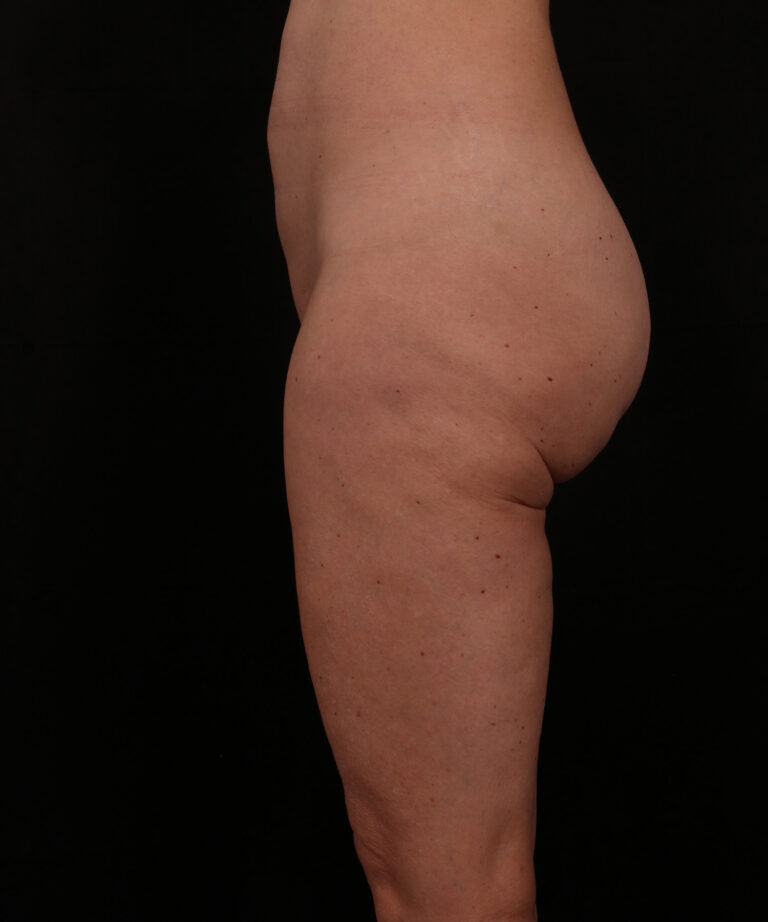 Before Image: Outer Thigh Lift - left-side