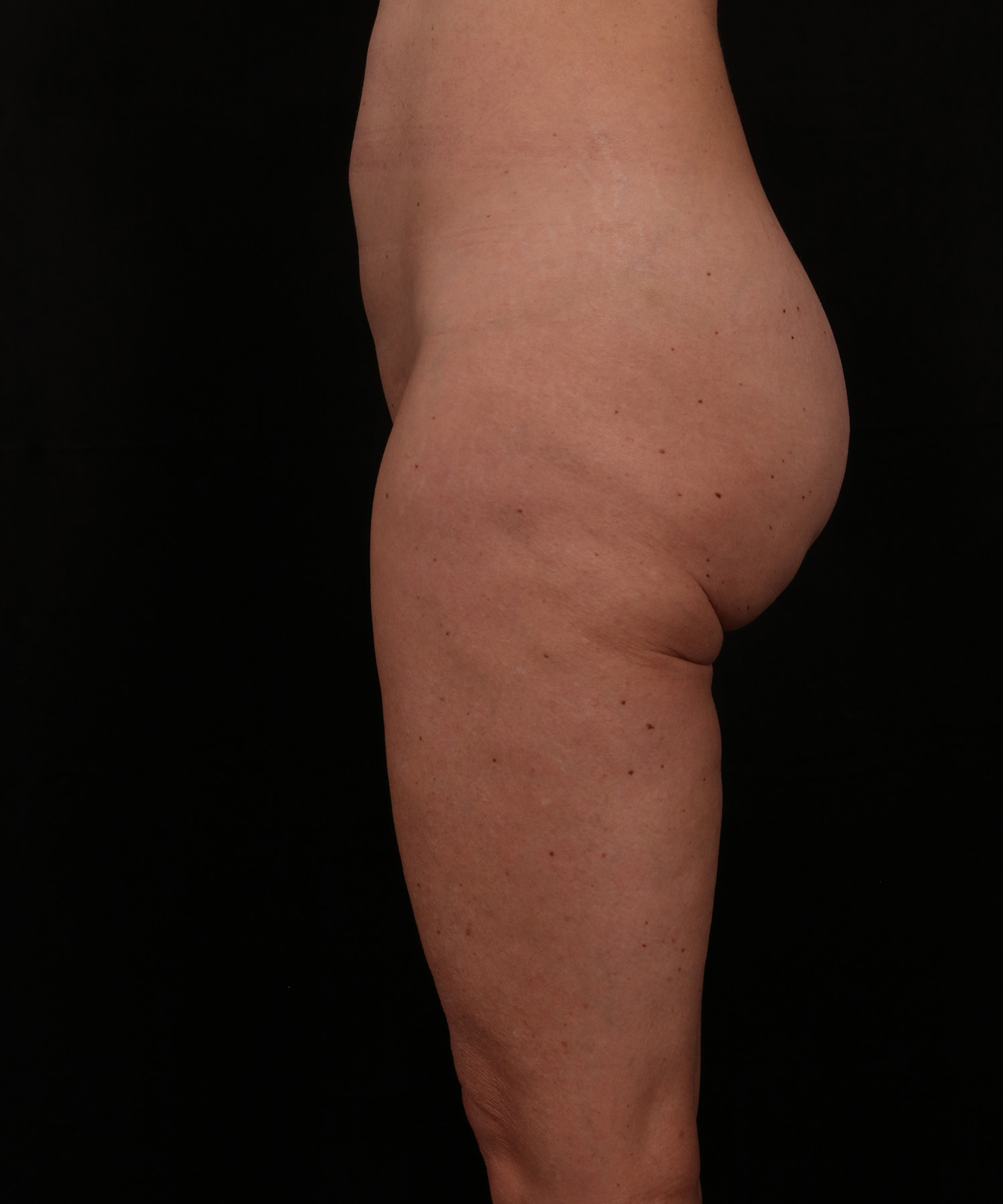 Before Image: Outer Thigh Lift - left-side