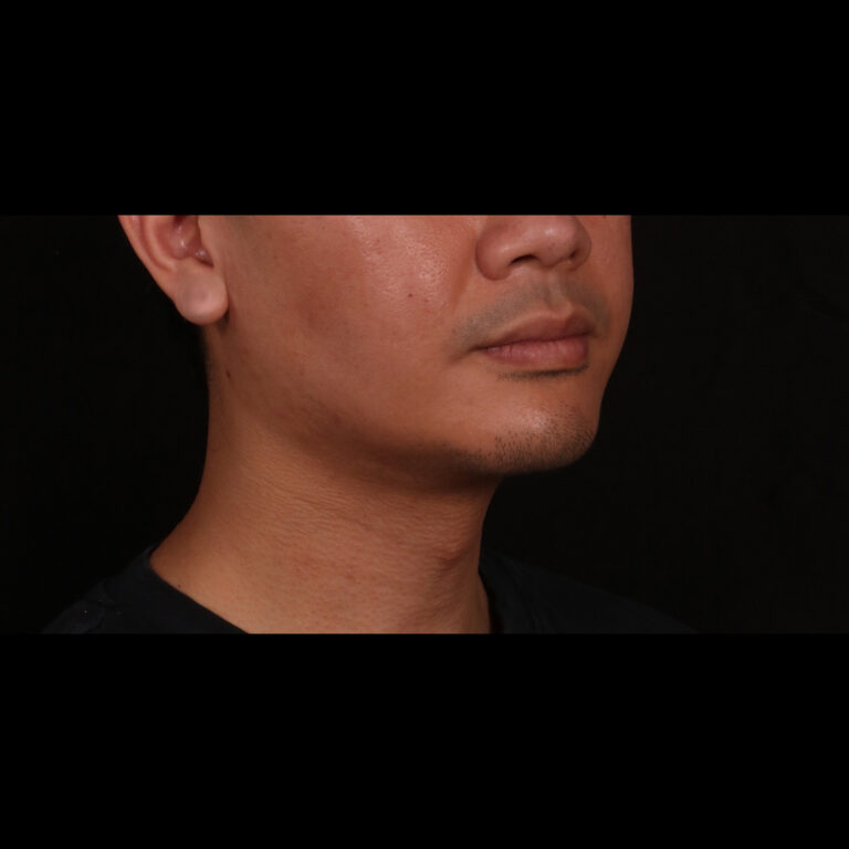 After Image: Buccal Fat Removal, Chin Implant and Neck Liposuction with Renuvion - right-front-oblique