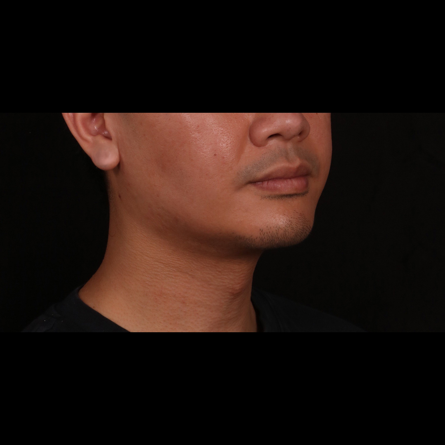 After Image: Buccal Fat Removal, Chin Implant and Neck Liposuction with Renuvion - right-front-oblique