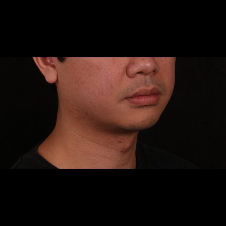 Before Image: Buccal Fat Removal, Chin Implant and Neck Liposuction with Renuvion - right-front-oblique
