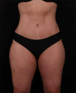 After Image: Tummy Tuck