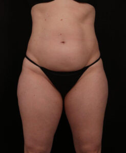 Before Image: Tummy Tuck