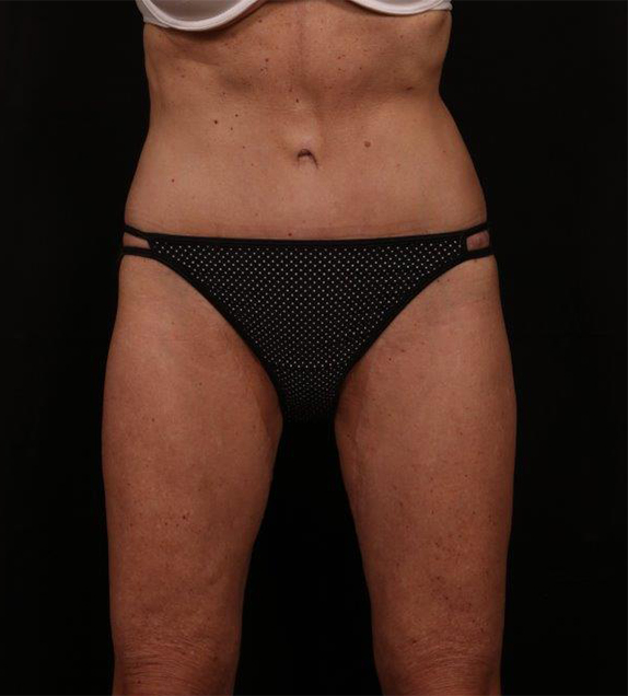 After Image: Tummy Tuck - front