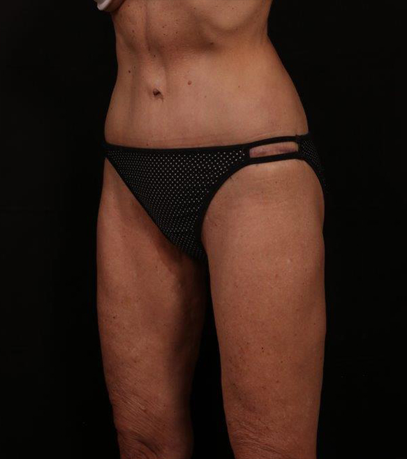 After Image: Tummy Tuck - left-front-oblique