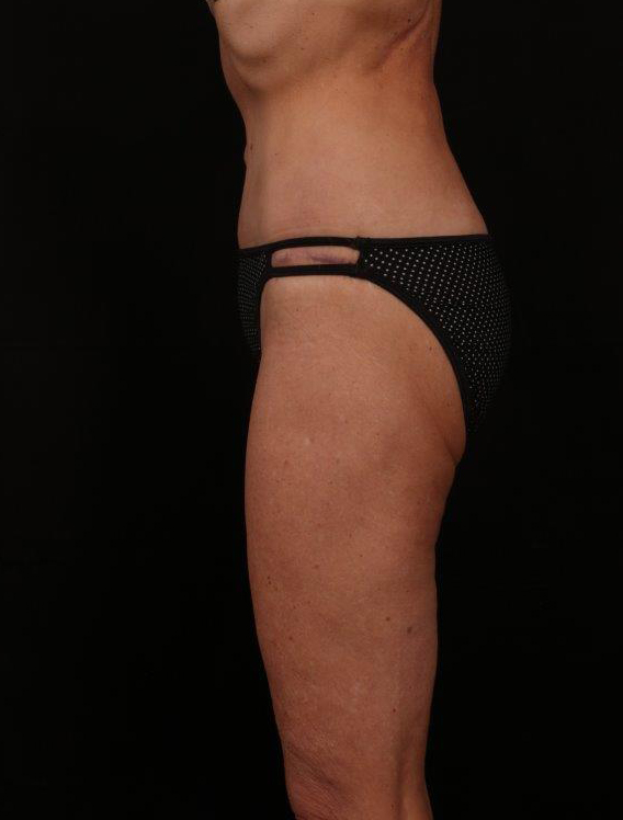 After Image: Tummy Tuck - left-side
