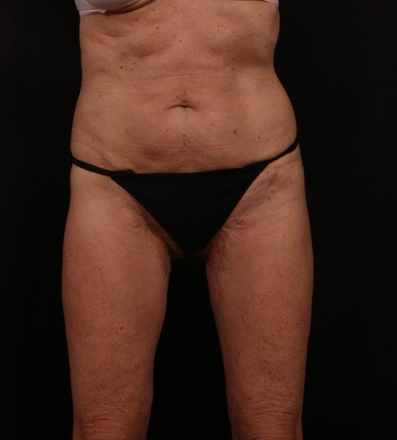 Before Image: Tummy Tuck - front