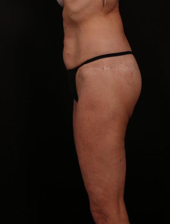Before Image: Tummy Tuck - left-side