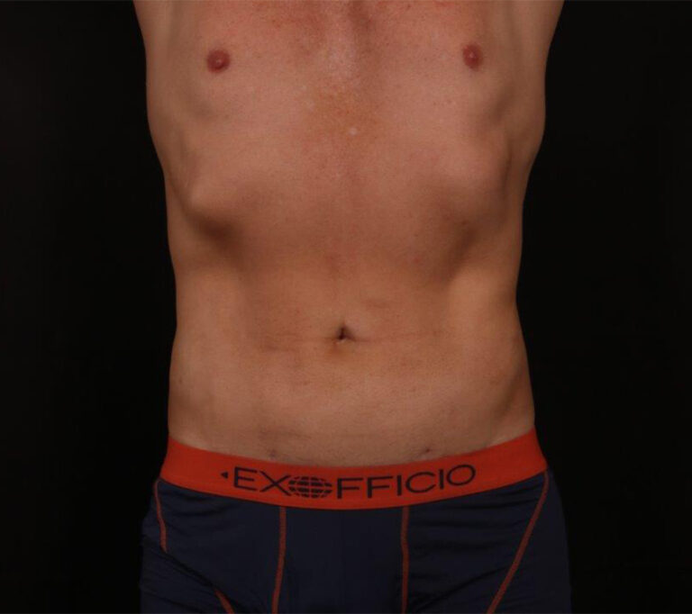 After Image: Liposuction - front