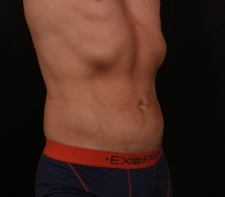 After Image: Liposuction - right-front-oblique