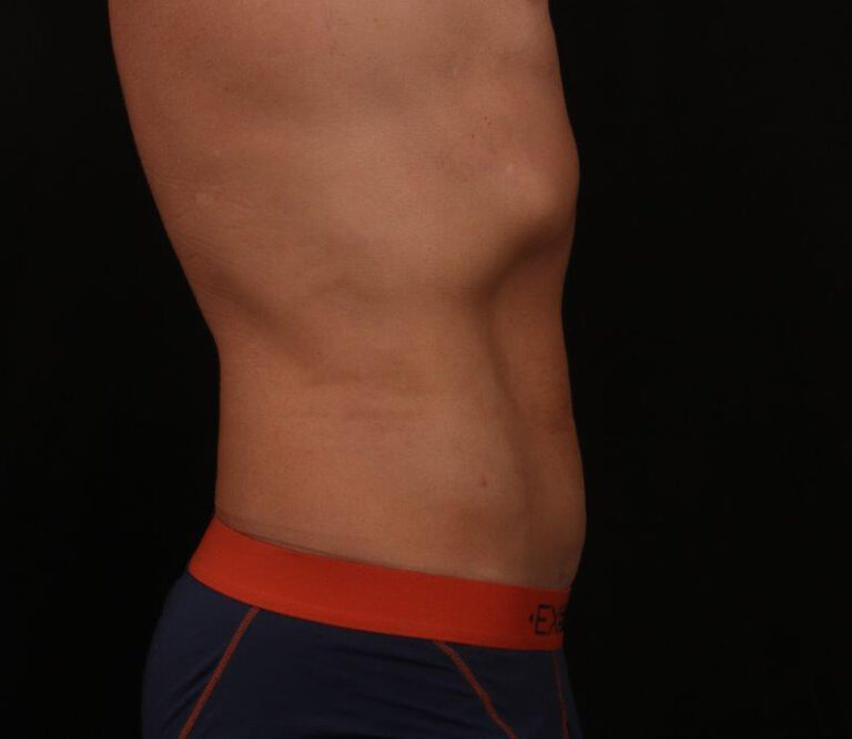 After Image: Liposuction - right-side