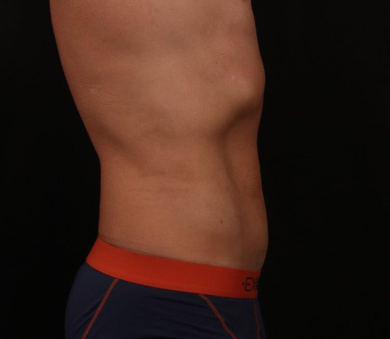After Image: Liposuction - right-side