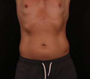 Before Image: Liposuction