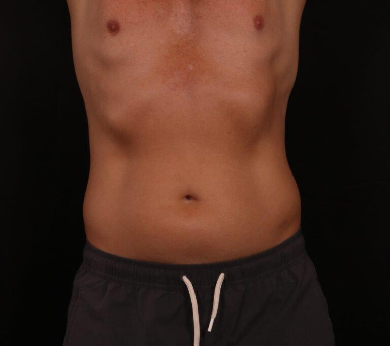 Before Image: Liposuction - front