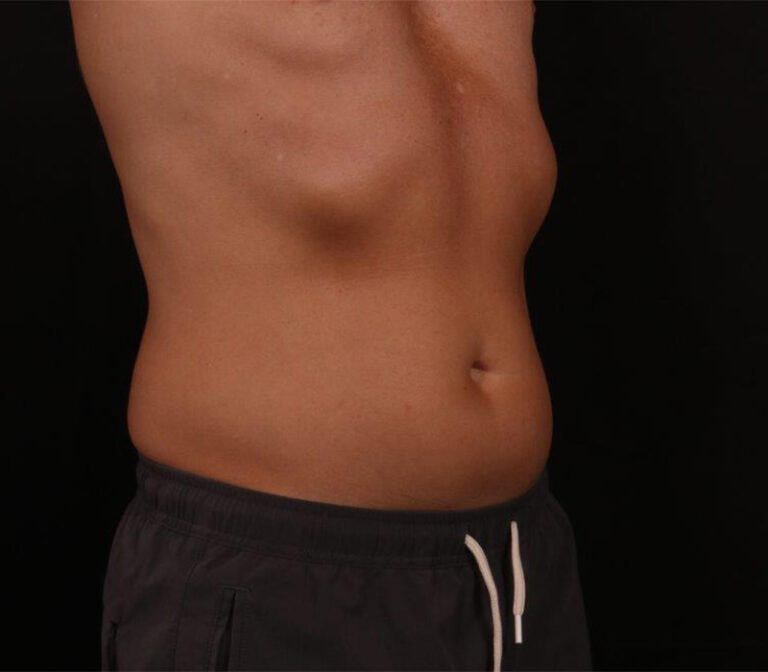Before Image: Liposuction - right-front-oblique