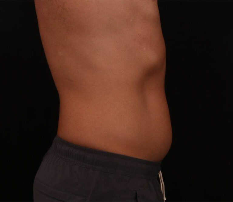 Before Image: Liposuction - right-side