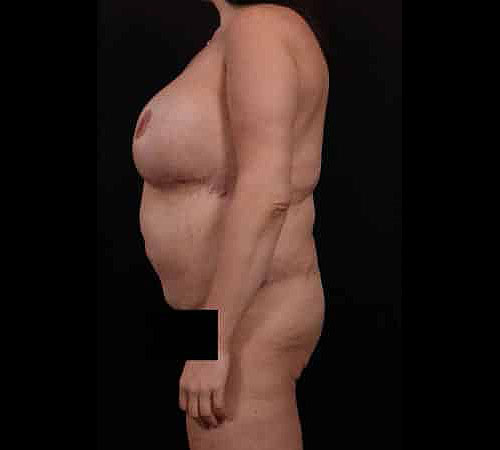 After Image: Body Lift - left-side