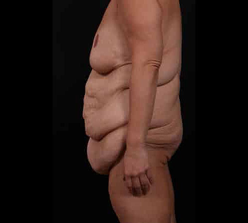 Before Image: Body Lift - left-side