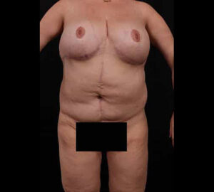 After Image: Body Lift