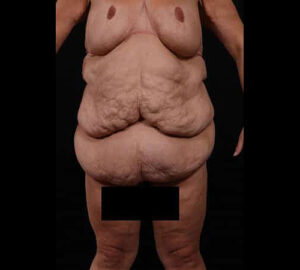 Before Image: Body Lift