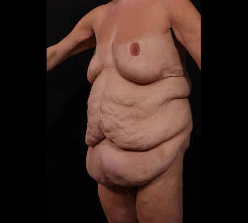 Before Image: Body Lift - left-front-oblique