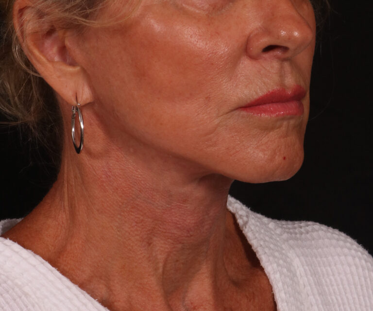 After Image: Lower Facelift - right-front-oblique