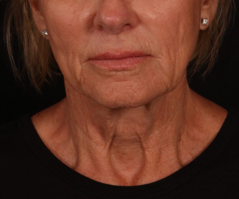 Before Image: Lower Facelift - front