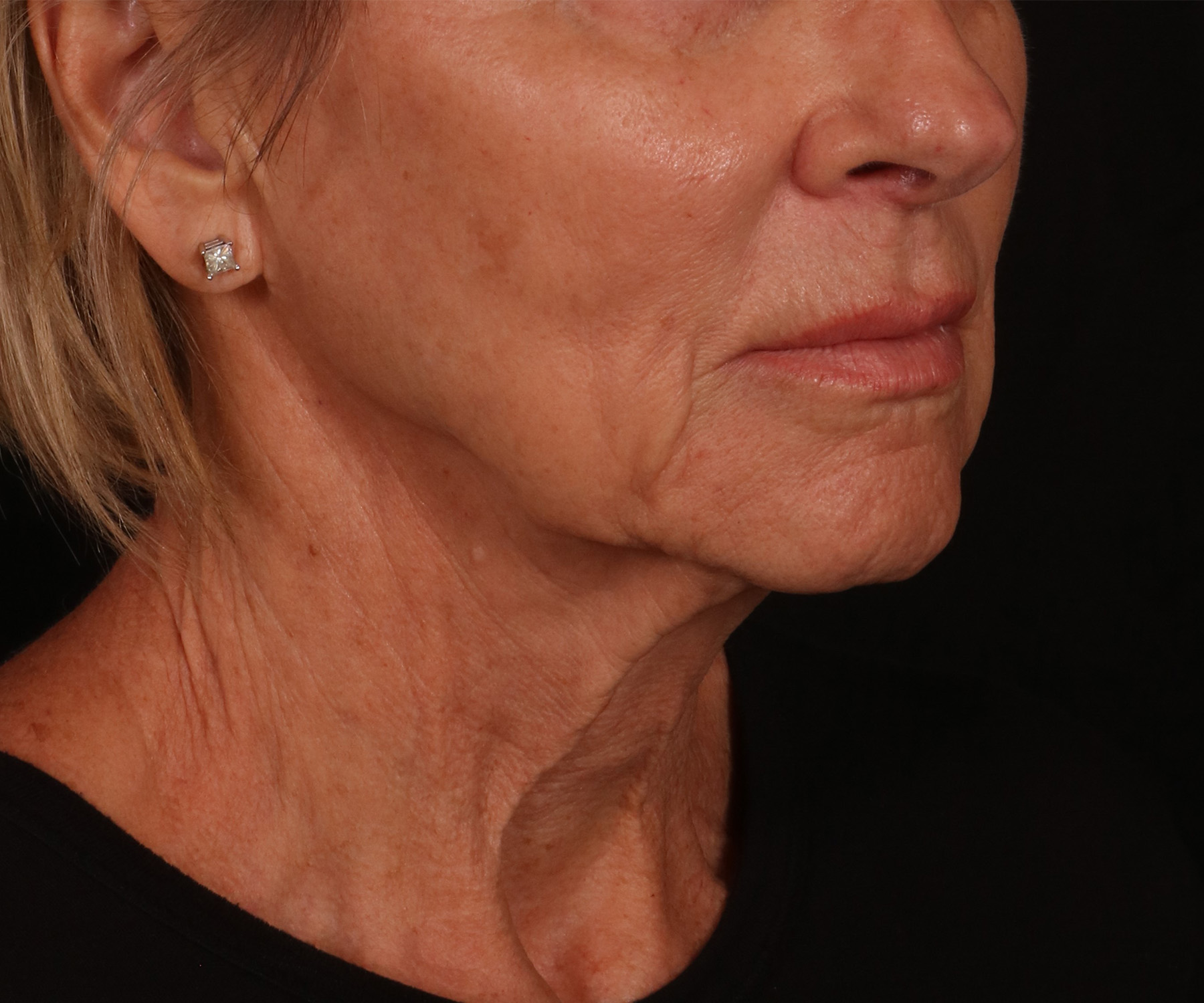 Before Image: Lower Facelift - right-front-oblique
