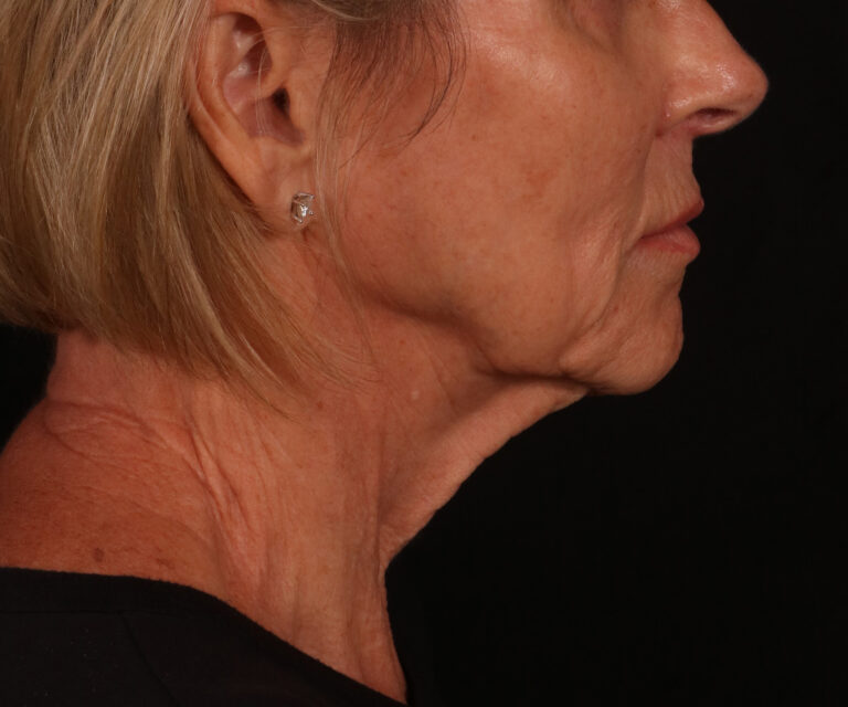 Before Image: Lower Facelift - right-side